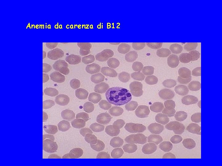 Anemia da carenza di B 12 