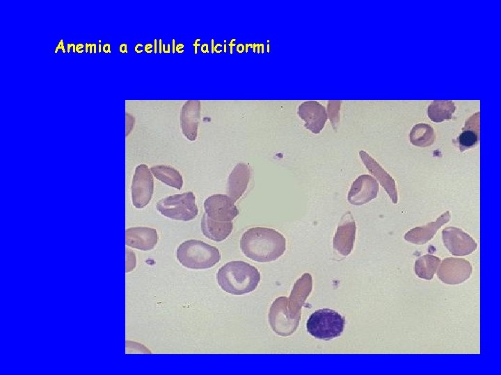 Anemia a cellule falciformi 