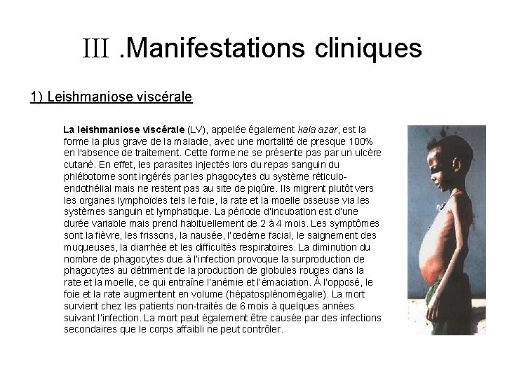  . Manifestations cliniques 1) Leishmaniose viscérale La leishmaniose viscérale (LV), appelée également kala