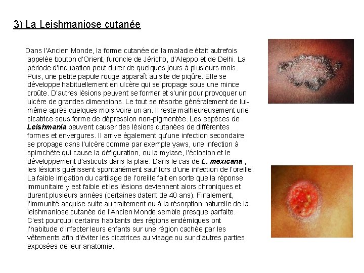 3) La Leishmaniose cutanée Dans l’Ancien Monde, la forme cutanée de la maladie était