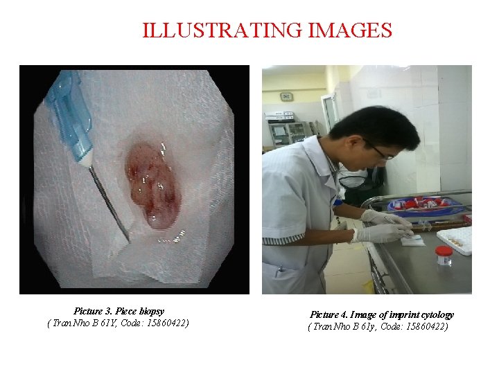 ILLUSTRATING IMAGES Picture 3. Piece biopsy ( Tran Nho B 61 Y, Code: 15860422)
