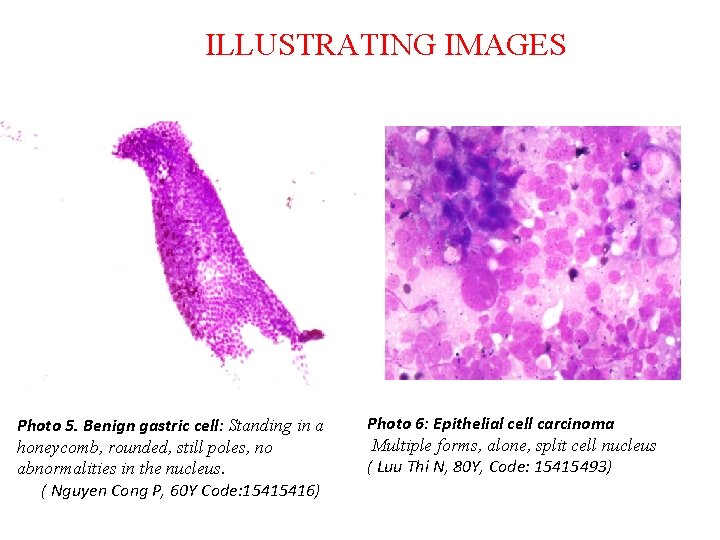 ILLUSTRATING IMAGES Photo 5. Benign gastric cell: Standing in a honeycomb, rounded, still poles,