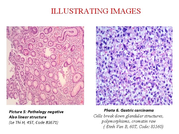 ILLUSTRATING IMAGES Picture 5: Pathology negative Also linear structure (Le Thi H, 45 T,