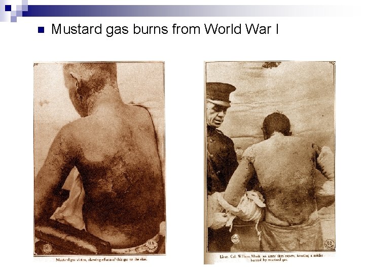 n Mustard gas burns from World War I 