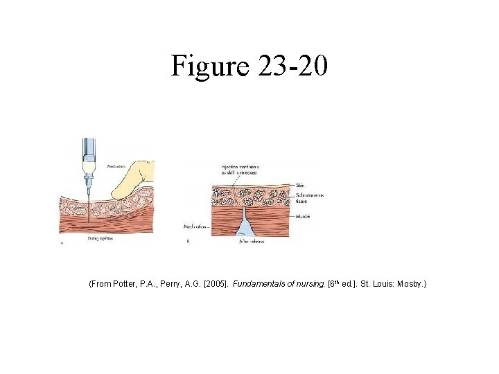 Figure 23 -20 (From Potter, P. A. , Perry, A. G. [2005]. Fundamentals of