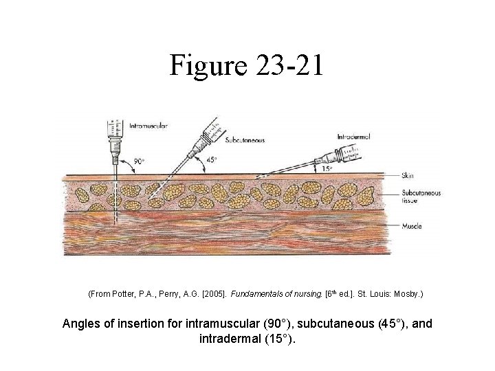 Figure 23 -21 (From Potter, P. A. , Perry, A. G. [2005]. Fundamentals of