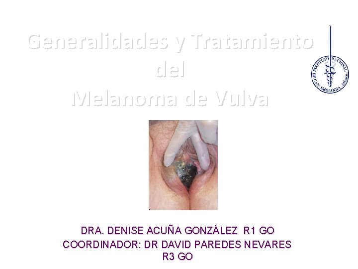 Generalidades y Tratamiento del Melanoma de Vulva DRA. DENISE ACUÑA GONZÁLEZ R 1 GO