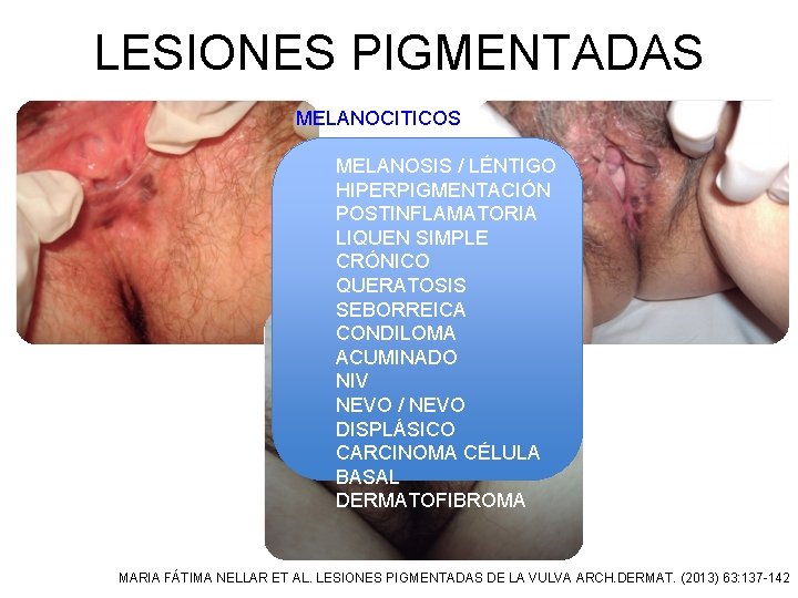 LESIONES PIGMENTADAS MELANOCITICOS MELANOSIS / LÉNTIGO HIPERPIGMENTACIÓN POSTINFLAMATORIA LIQUEN SIMPLE CRÓNICO QUERATOSIS SEBORREICA CONDILOMA