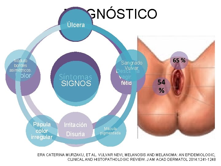 DIAGNÓSTICO Prurito Úlcera Nódulo bordes asimétricos. 65 % Sangrado Vulvar Síntomas Dolor SIGNOS Pápula