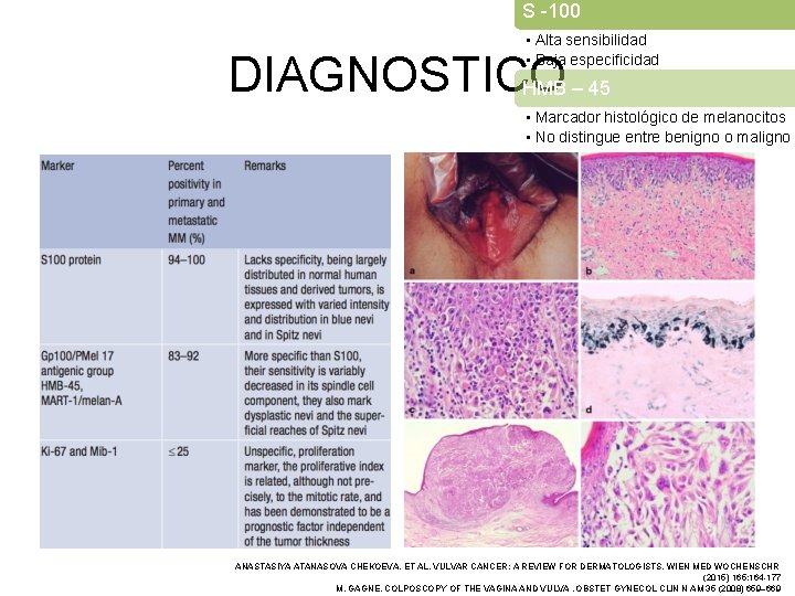 S -100 • Alta sensibilidad • Baja especificidad DIAGNOSTICO HMB – 45 • Marcador