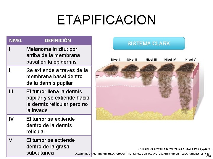 ETAPIFICACION NIVEL DEFINICIÓN SISTEMA CLARK I Melanoma in situ: por arriba de la membrana