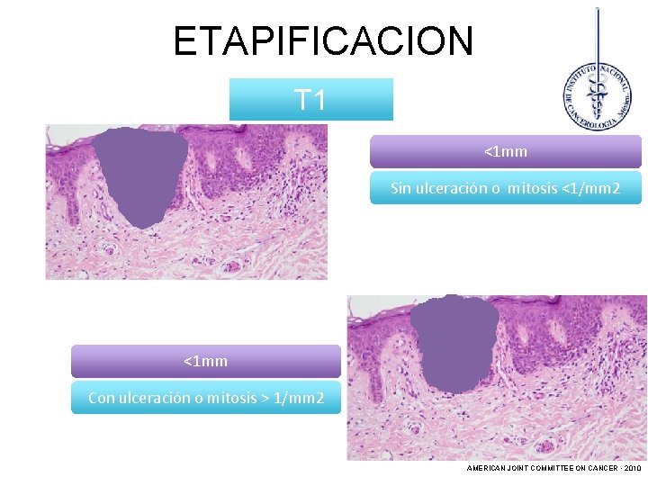 ETAPIFICACION T 1 <1 mm Sin ulceración o mitosis <1/mm 2 <1 mm Con