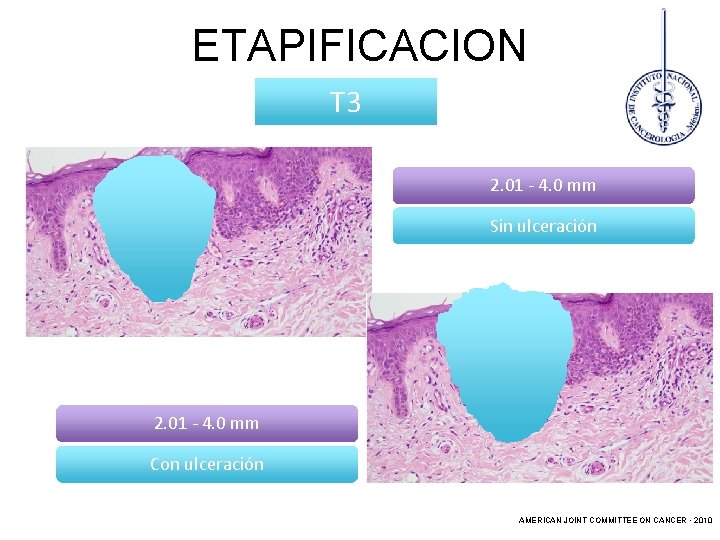ETAPIFICACION T 3 2. 01 - 4. 0 mm Sin ulceración 2. 01 -