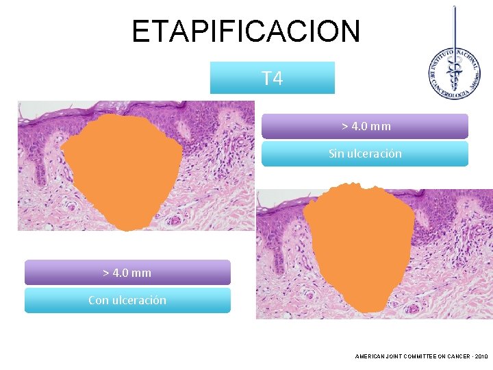 ETAPIFICACION T 4 > 4. 0 mm Sin ulceración > 4. 0 mm Con