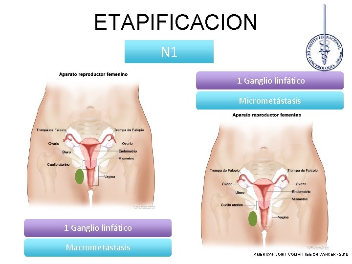 ETAPIFICACION N 1 1 Ganglio linfático Micrometástasis 1 Ganglio linfático Macrometástasis AMERICAN JOINT COMMITTEE