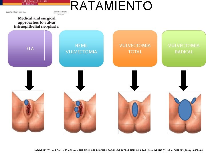 TRATAMIENTO ELA HEMIVULVECTOMIA TOTAL VULVECTOMIA RADICAL KYMBERLY W. LAI ET AL. MEDICAL AND SURGICAL