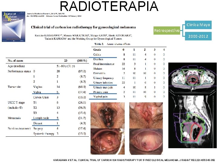 RADIOTERAPIA Clínica Mayo Retrospectivo 2000 -2012 KARASAWA K ET AL. CLINICAL TRIAL OF CARBON