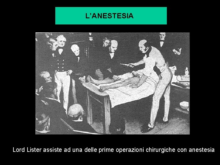 L’ANESTESIA Lord Lister assiste ad una delle prime operazioni chirurgiche con anestesia 