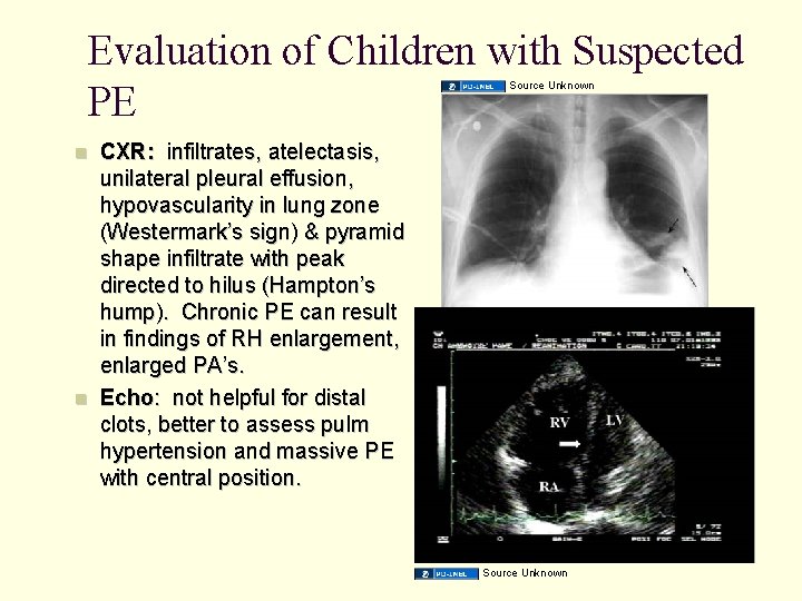 Evaluation of Children with Suspected PE Source Unknown CXR: infiltrates, atelectasis, unilateral pleural effusion,