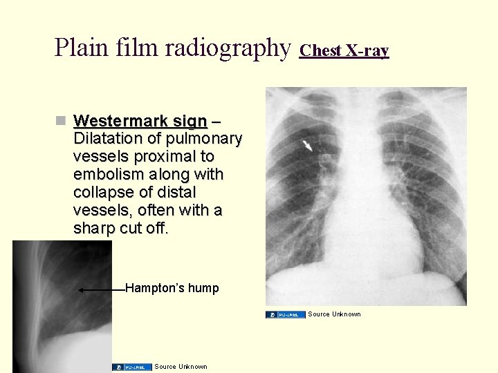 Plain film radiography Chest X-ray Westermark sign – Dilatation of pulmonary vessels proximal to