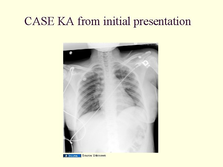 CASE KA from initial presentation Source Unknown 