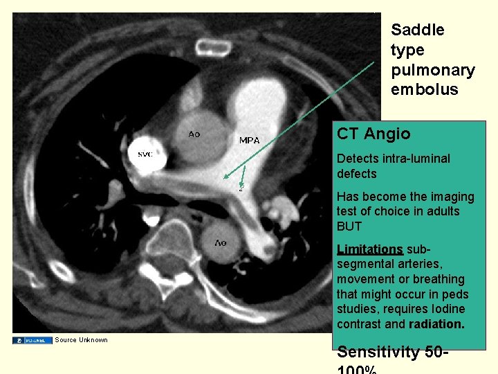 Saddle type pulmonary embolus CT Angio Detects intra-luminal defects Has become the imaging test