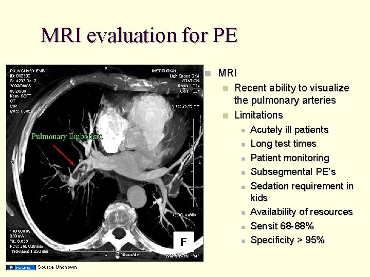 MRI evaluation for PE MRI Recent ability to visualize the pulmonary arteries Limitations Source