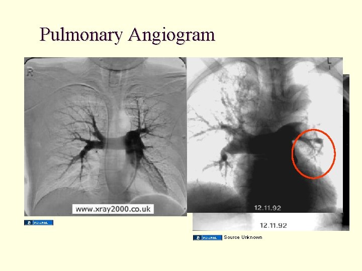 Pulmonary Angiogram Source Unknown 