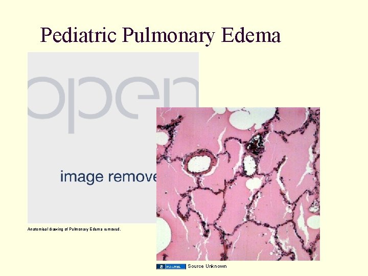 Pediatric Pulmonary Edema Anatomical drawing of Pulmonary Edema removed. Source Unknown 