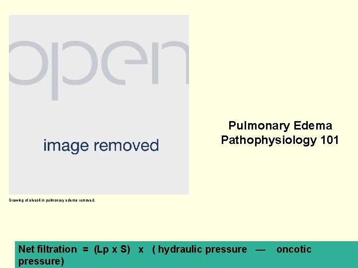 Pulmonary Edema Pathophysiology 101 Drawing of alveoli in pulmonary edema removed. Net filtration =