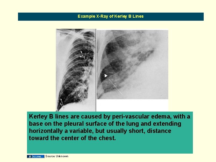 Example X-Ray of Kerley B Lines Kerley B lines are caused by peri-vascular edema,