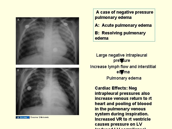  A case of negative pressure pulmonary edema A: Acute pulmonary edema B: Resolving