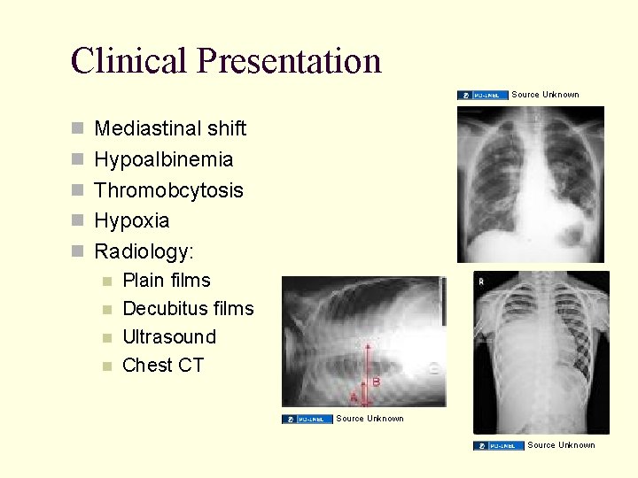 Clinical Presentation Source Unknown Mediastinal shift Hypoalbinemia Thromobcytosis Hypoxia Radiology: Plain films Decubitus films Clinical Presentation Source Unknown Mediastinal shift Hypoalbinemia Thromobcytosis Hypoxia Radiology: Plain films Decubitus films