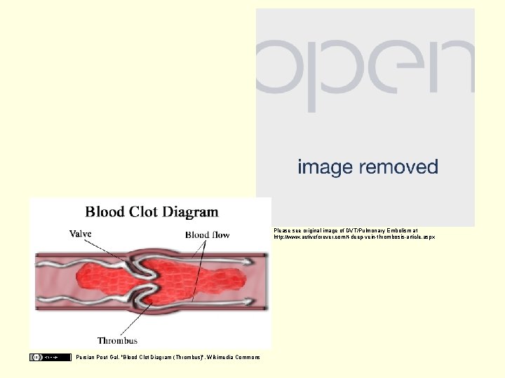 Please see original image of DVT/Pulmonary Embolism at http: //www. activeforever. com/t-deep-vein-thrombosis-article. aspx Persian