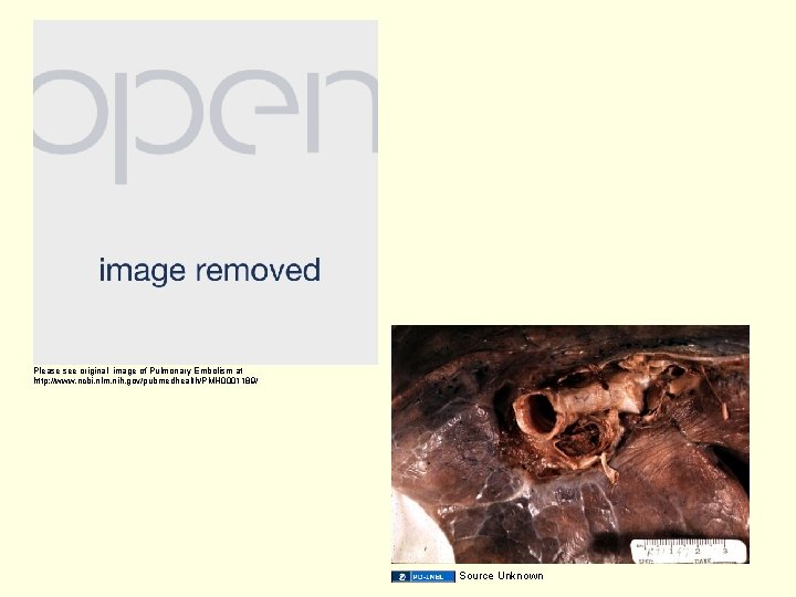 Please see original image of Pulmonary Embolism at http: //www. ncbi. nlm. nih. gov/pubmedhealth/PMH