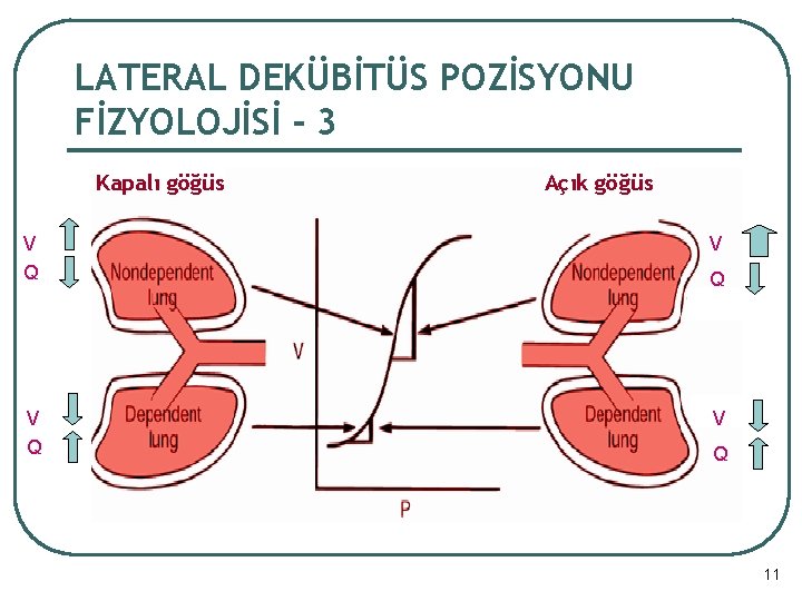 LATERAL DEKÜBİTÜS POZİSYONU FİZYOLOJİSİ - 3 Kapalı göğüs Açık göğüs V Q V Q