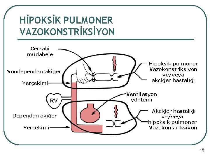 HİPOKSİK PULMONER VAZOKONSTRİKSİYON Cerrahi müdahele Nondependan akiğer Yerçekimi Hipoksik pulmoner Vazokonstriksiyon ve/veya akciğer hastalığı