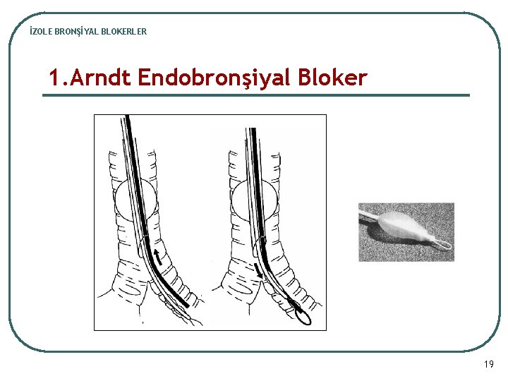 İZOLE BRONŞİYAL BLOKERLER 1. Arndt Endobronşiyal Bloker 19 