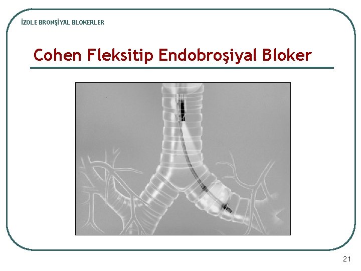 İZOLE BRONŞİYAL BLOKERLER Cohen Fleksitip Endobroşiyal Bloker 21 