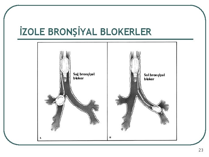 İZOLE BRONŞİYAL BLOKERLER Sağ bronşiyal bloker Sol bronşiyal bloker 23 