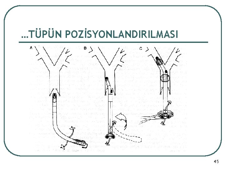 …TÜPÜN POZİSYONLANDIRILMASI 45 