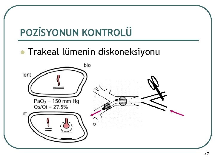 POZİSYONUN KONTROLÜ l Trakeal lümenin diskoneksiyonu 47 