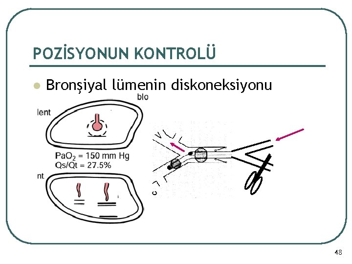 POZİSYONUN KONTROLÜ l Bronşiyal lümenin diskoneksiyonu 48 