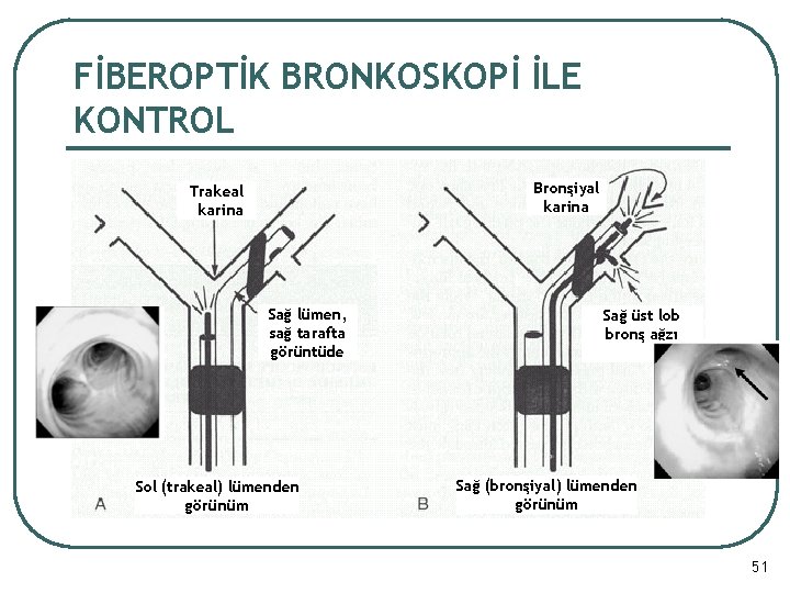 FİBEROPTİK BRONKOSKOPİ İLE KONTROL Bronşiyal karina Trakeal karina Sağ lümen, sağ tarafta görüntüde Sol