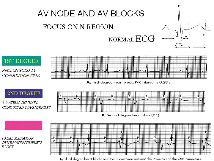 AV NODE AND AV BLOCKS FOCUS ON N REGION NORMAL 1 ST DEGREE PROLONGUED