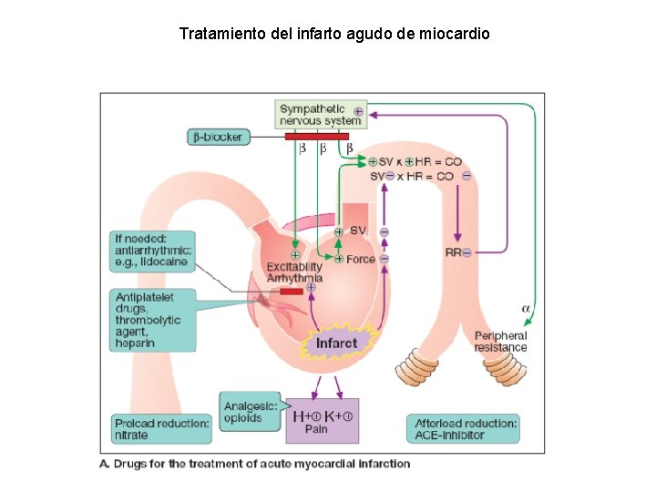 Tratamiento del infarto agudo de miocardio Tratamiento del infarto agudo de miocardio