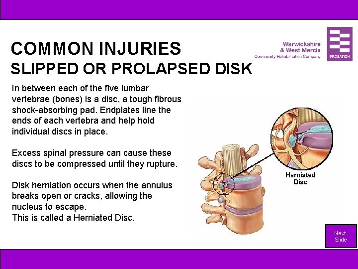 COMMON INJURIES SLIPPED OR PROLAPSED DISK In between each of the five lumbar vertebrae