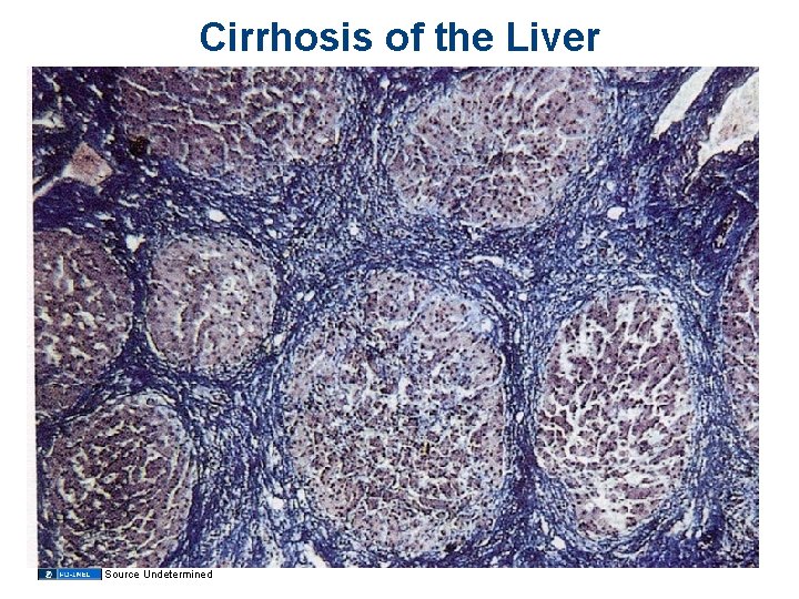 Cirrhosis of the Liver Source Undetermined 
