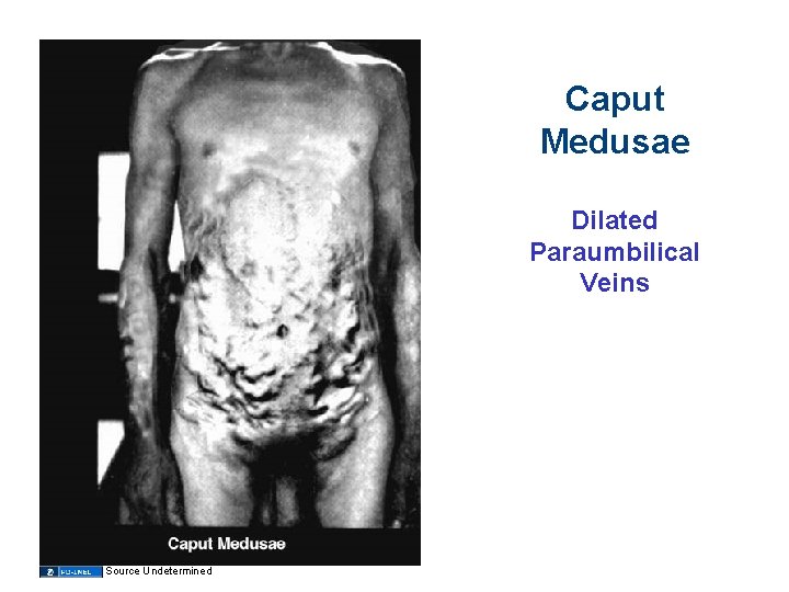 Caput Medusae Dilated Paraumbilical Veins Source Undetermined 