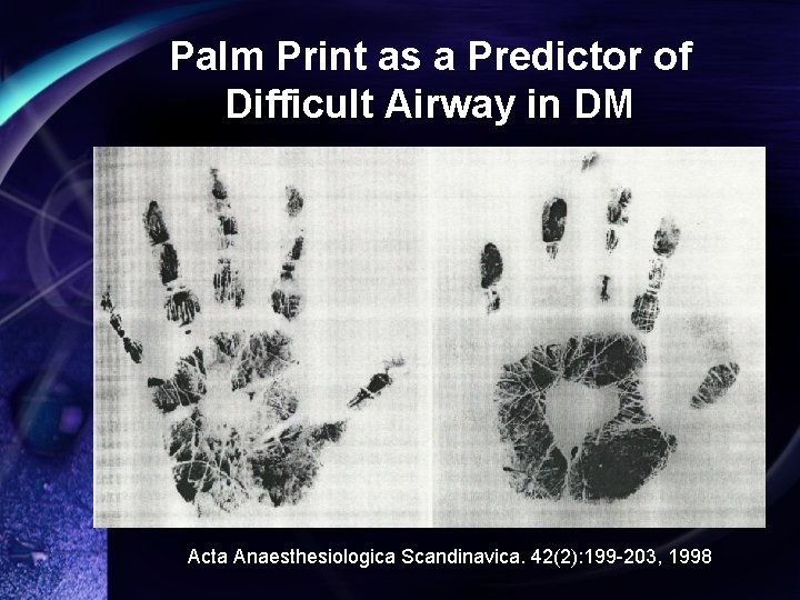 Palm Print as a Predictor of Difficult Airway in DM Acta Anaesthesiologica Scandinavica. 42(2):